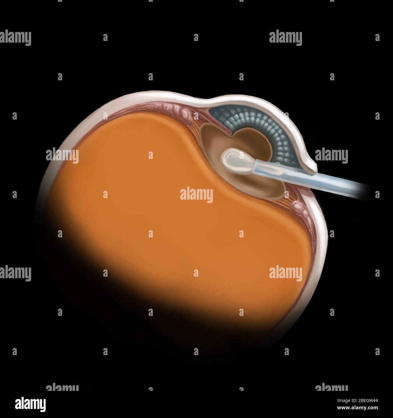 Lens Replacement Surgery Stock Photo Alamy