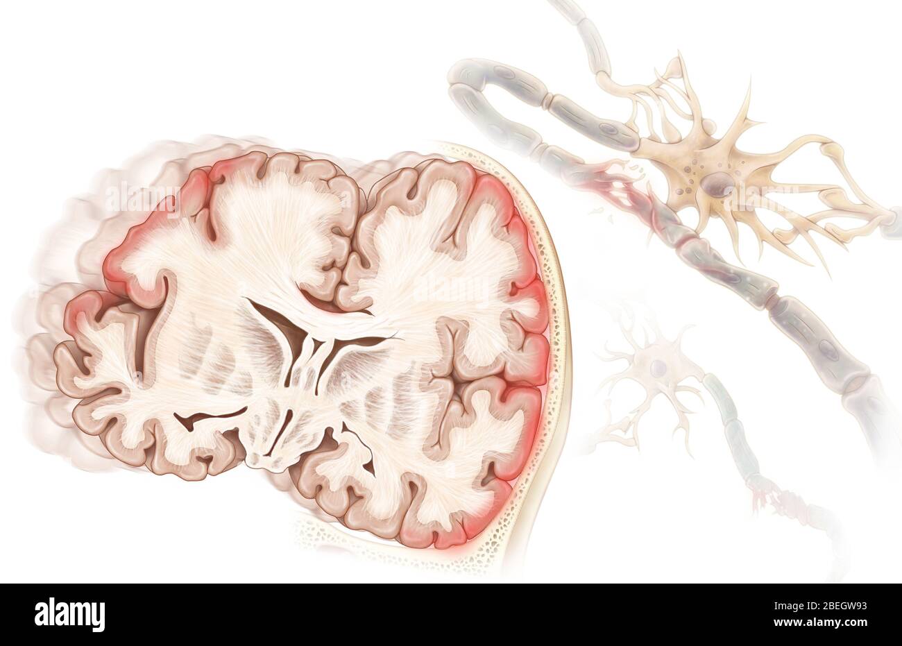 Diffuse Axonal Injury Gross