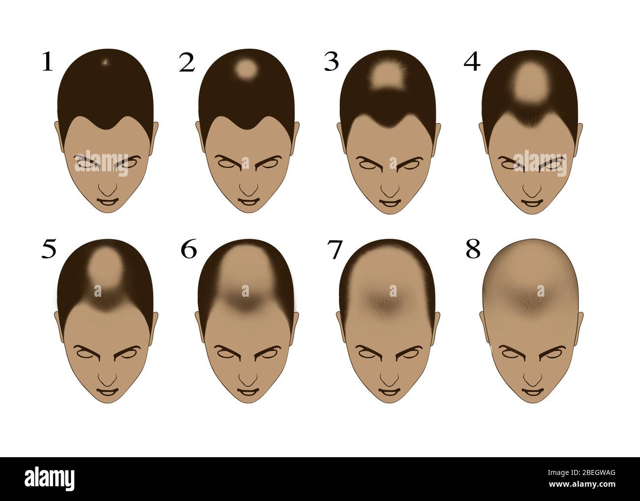Male pattern baldness stages hires stock photography and images Alamy