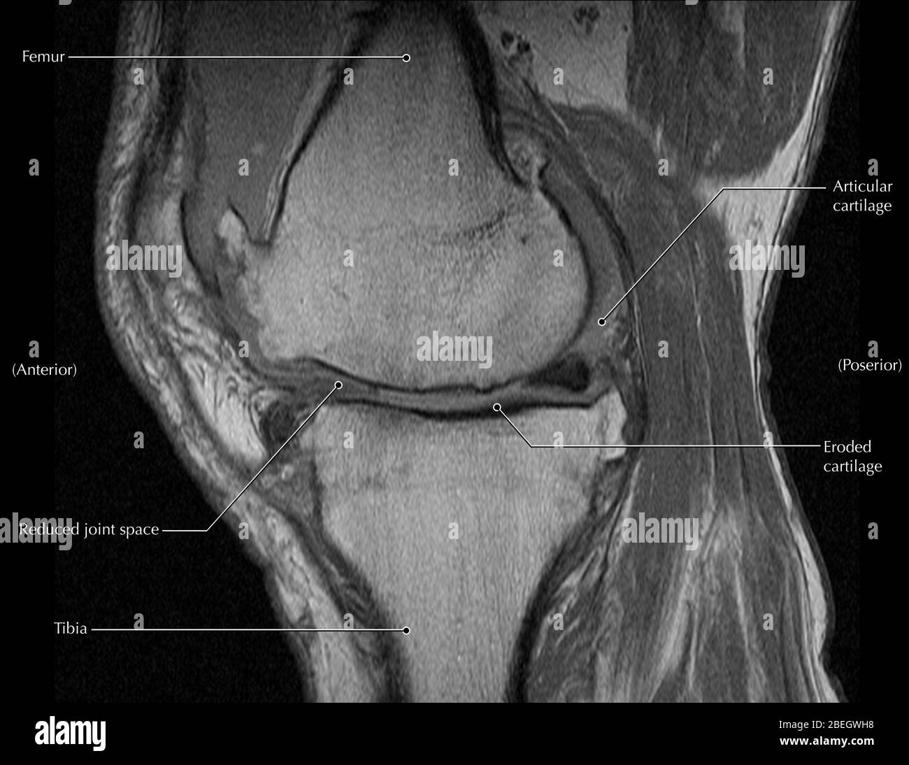 Knee Arthritis, MRI Stock Photo