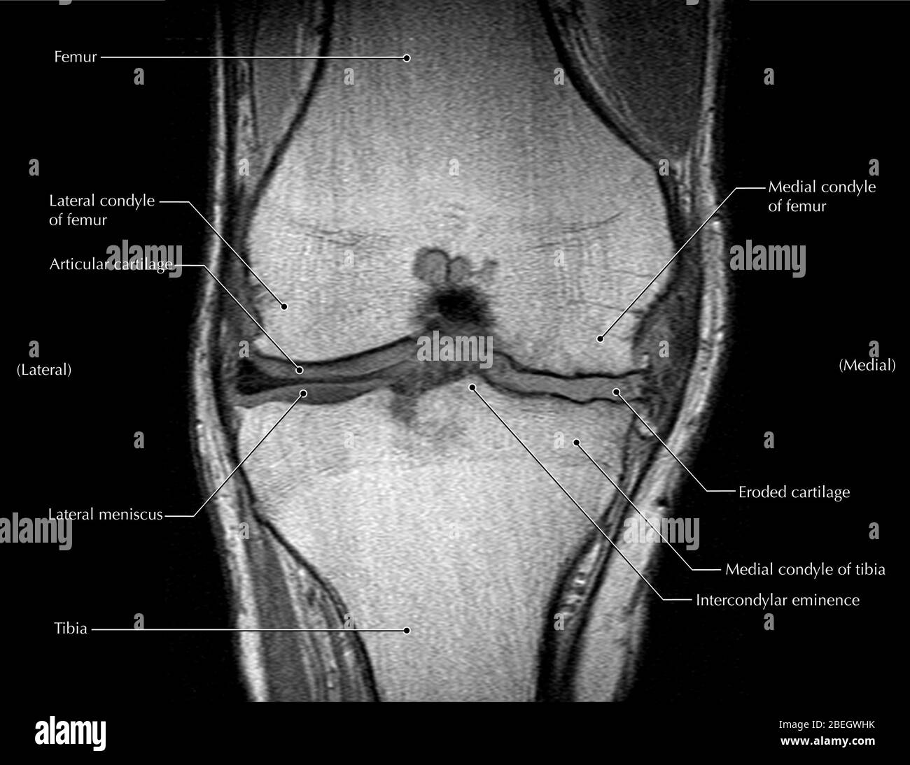 Knee Arthritis, MRI Stock Photo