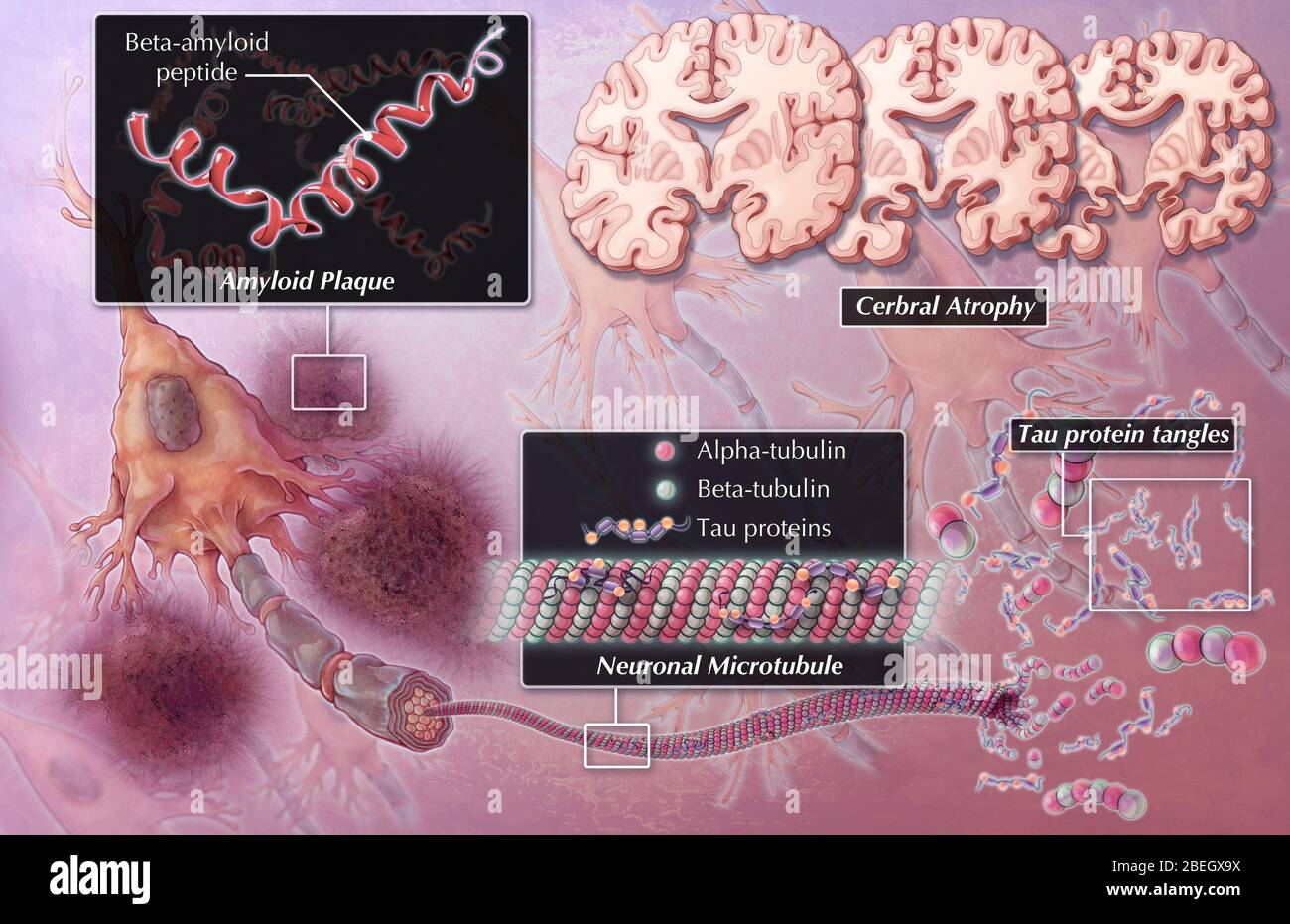 Alzheimer's Disease Pathology Stock Photo