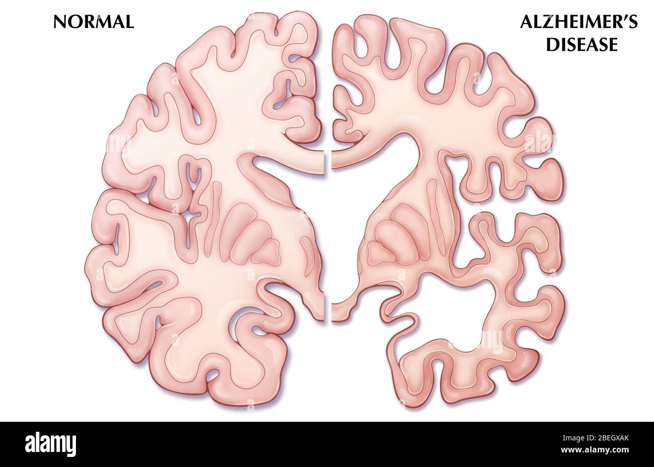 alzheimers disease patient clipart