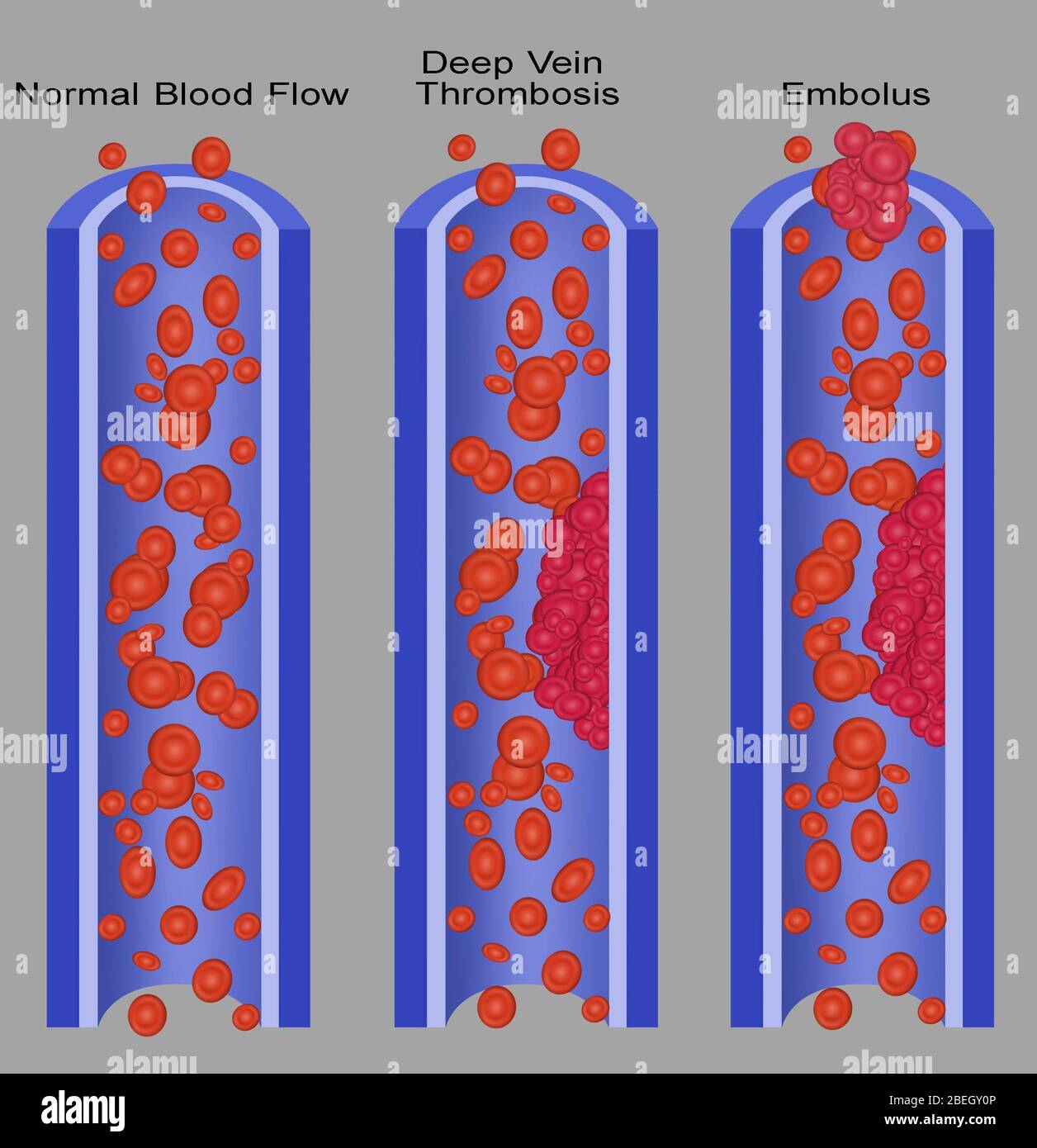 List 103+ Pictures Photos Of Blood Clots Updated