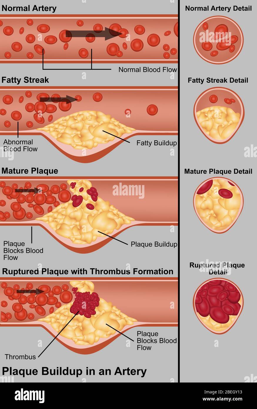 Artery Blockage High Resolution Stock Photography and Images Alamy