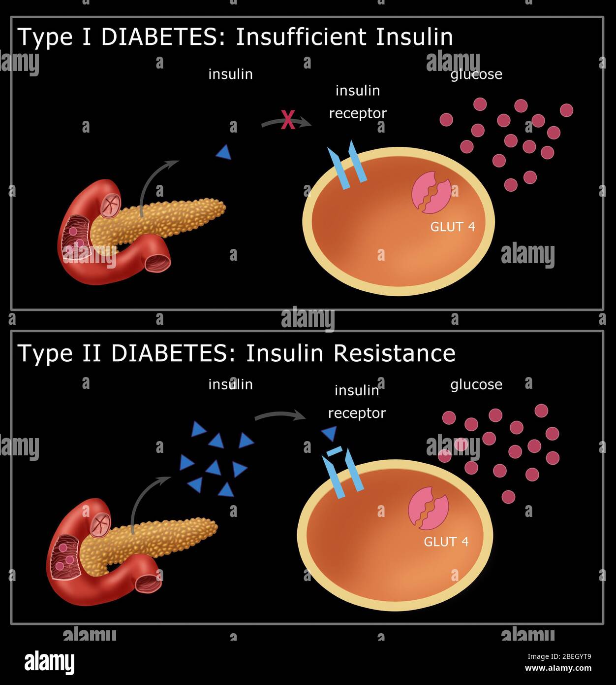 Diabetes I & II Stock Photo   Alamy