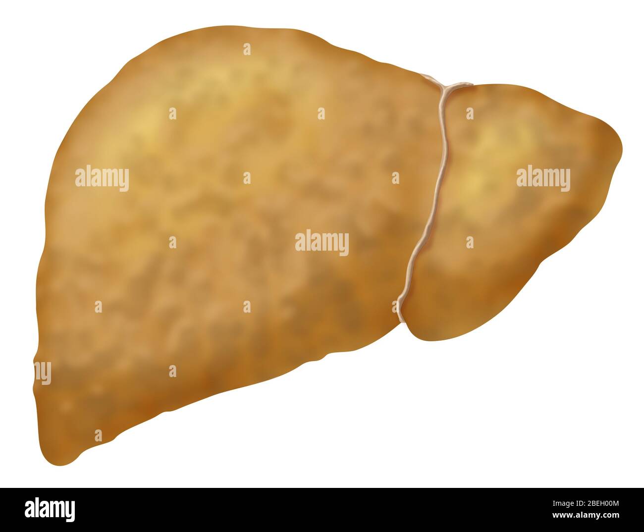 Fatty Liver Disease Stock Photo
