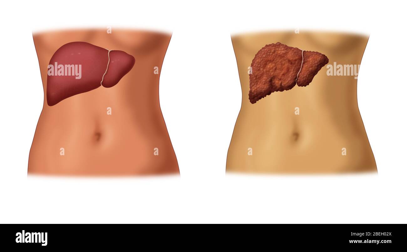 Healthy vs. Cirrhotic Liver Stock Photo