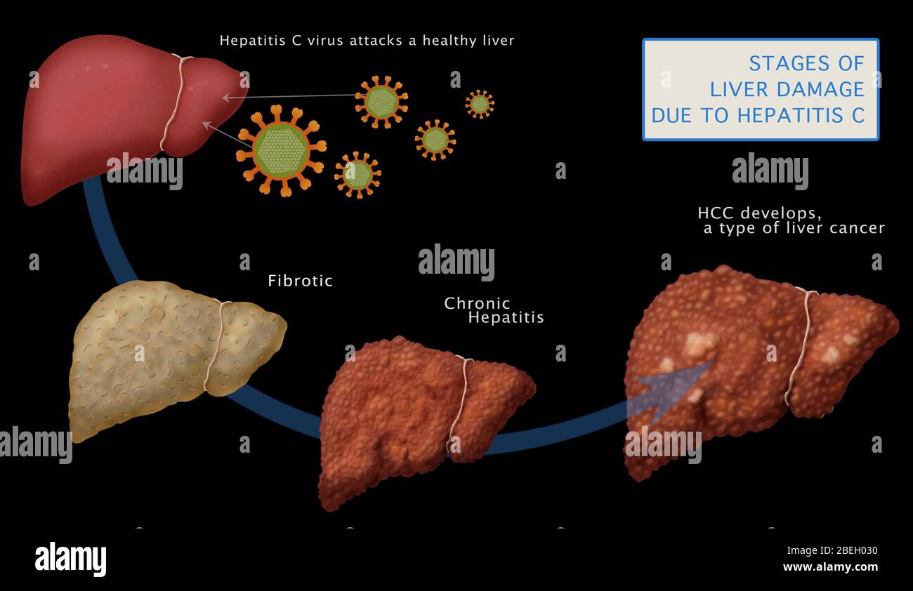 Liver Damage in Hepatitis C Stock Photo Alamy