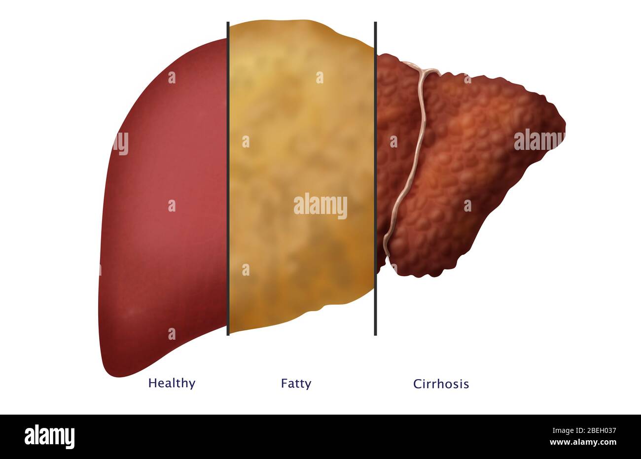 Healthy, Fatty, and Cirrhotic Liver Stock Photo