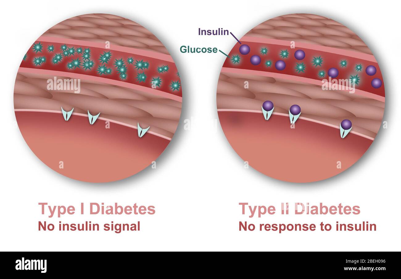 Type 1 and Type 2 Diabetes Stock Photo