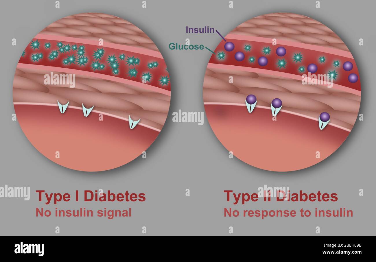 Type 1 and Type 2 Diabetes Stock Photo