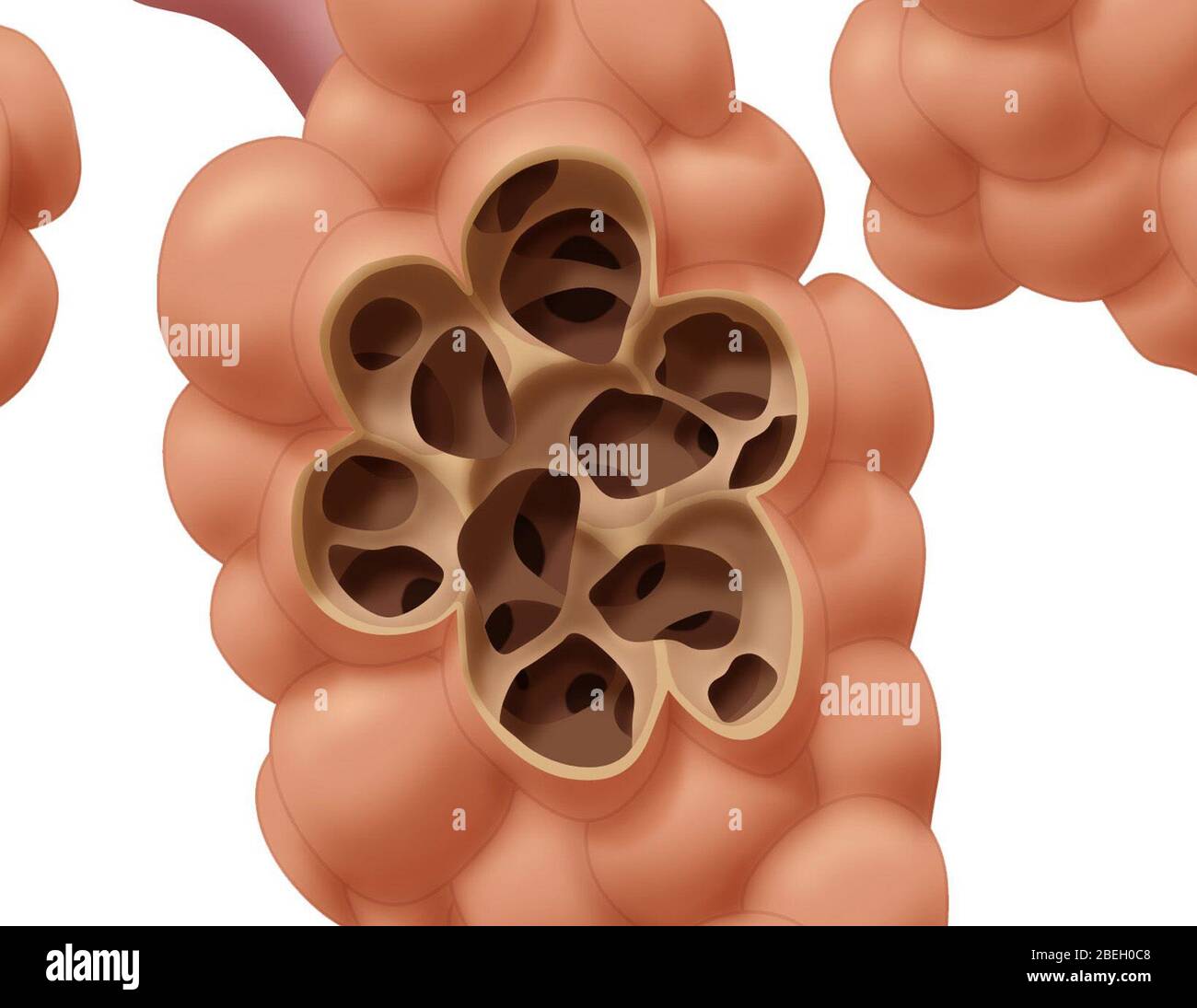 Damaged Alveoli Stock Photo