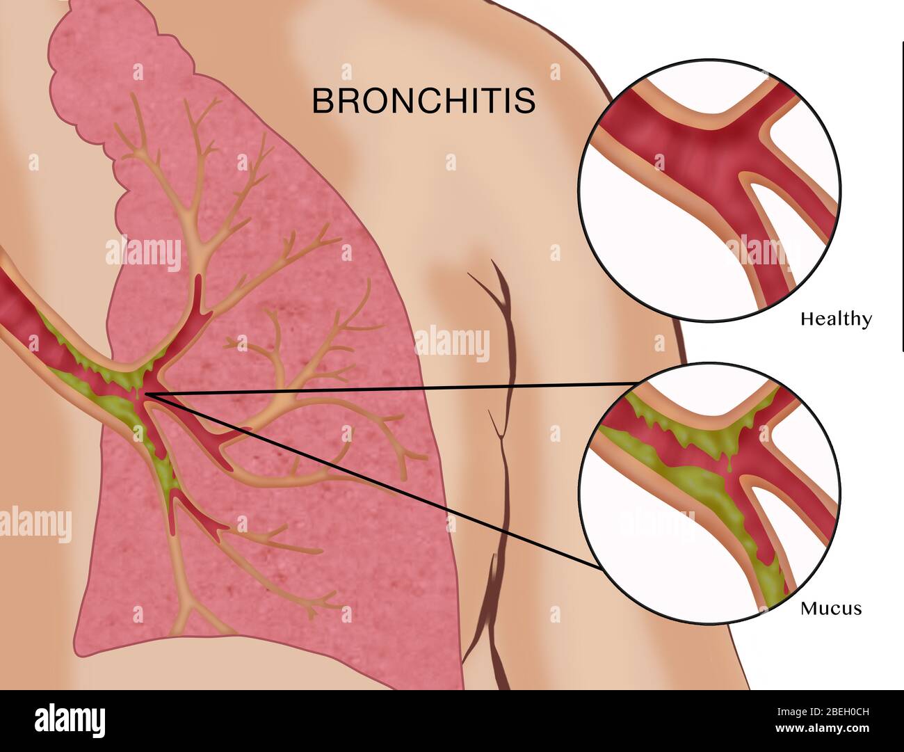 Bronchitis