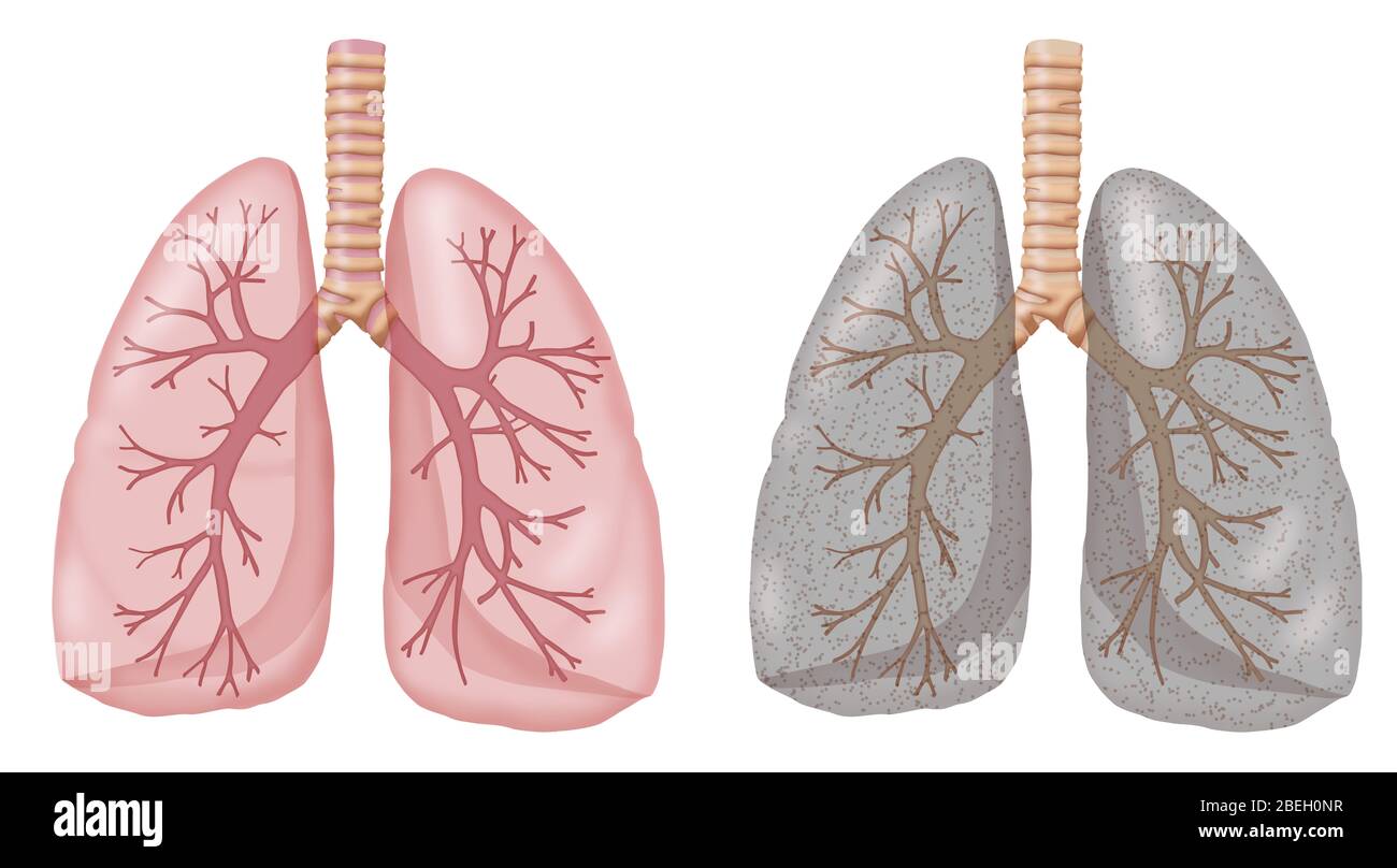 Lungs of Smoker vs. Non-Smoker Stock Photo