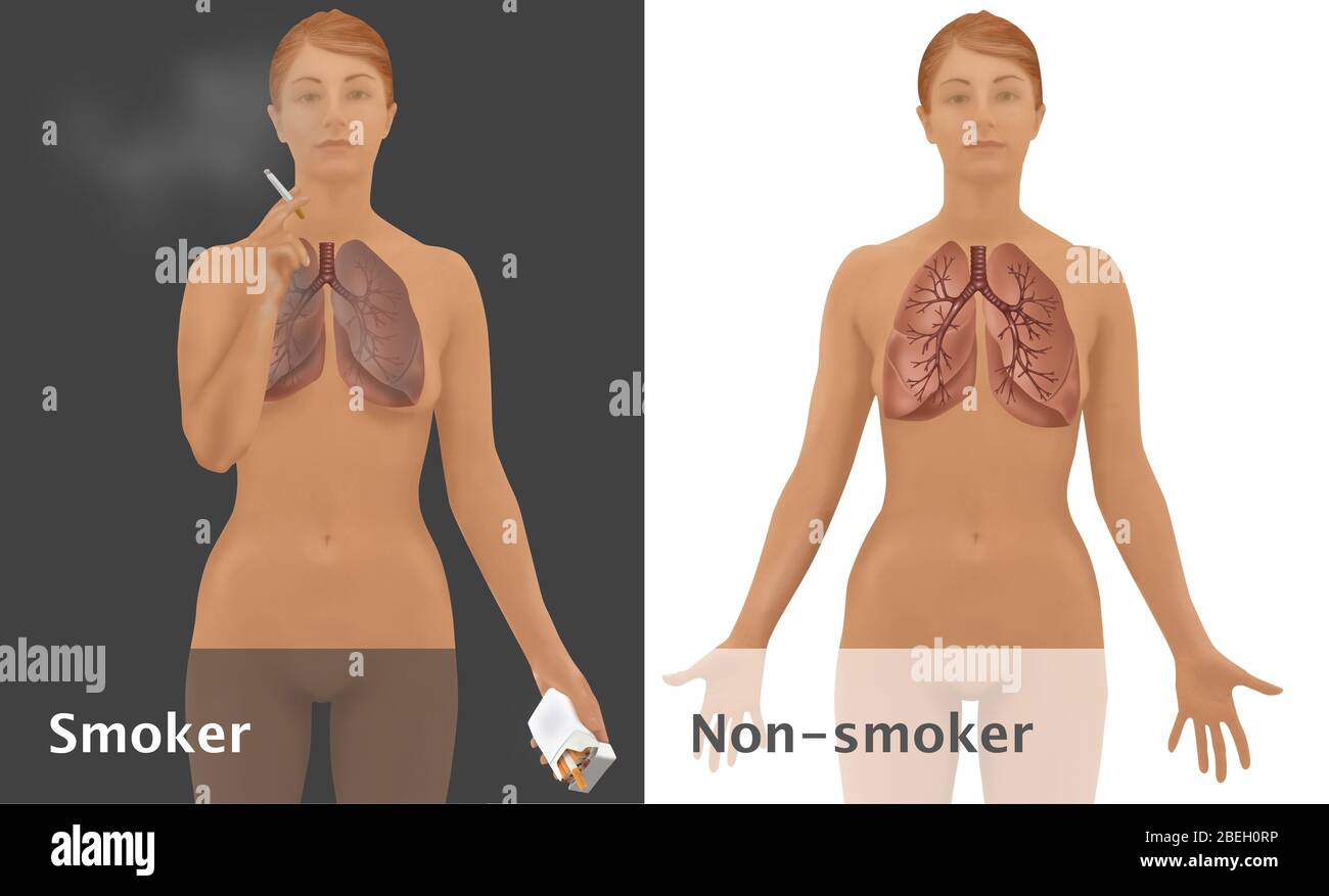 Lungs of Smoker vs. Non-Smoker Stock Photo