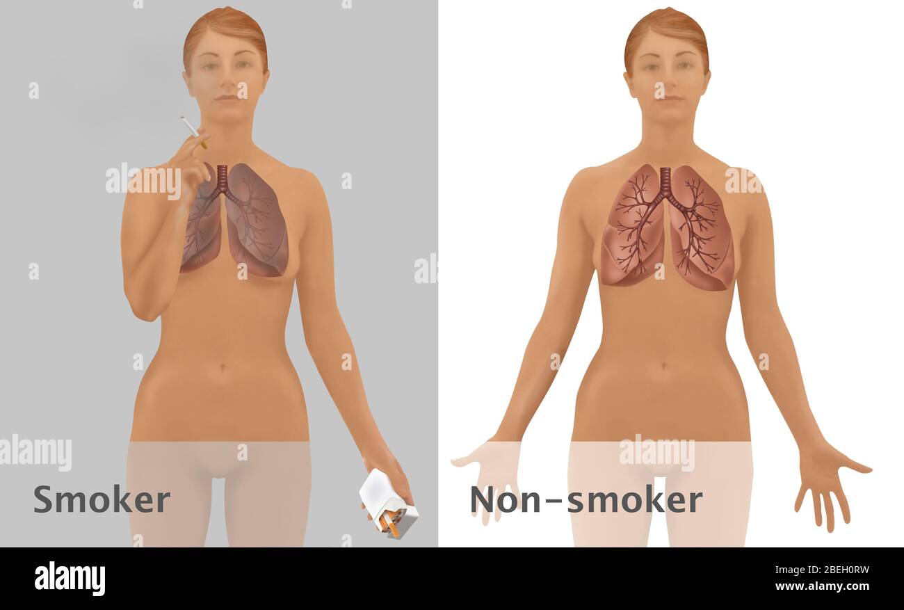 Lungs of Smoker vs. NonSmoker Stock Photo Alamy