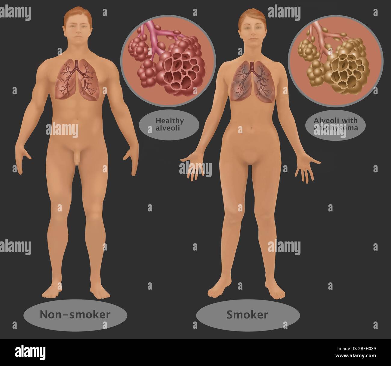 Lungs & Alveoli of Smoker vs. Non-Smoker Stock Photo