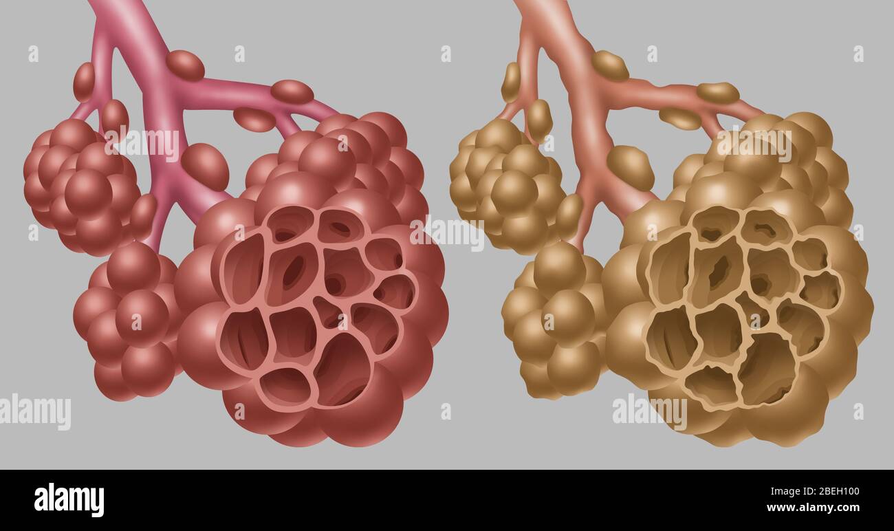 Normal vs. Emphysematous Alveoli Stock Photo