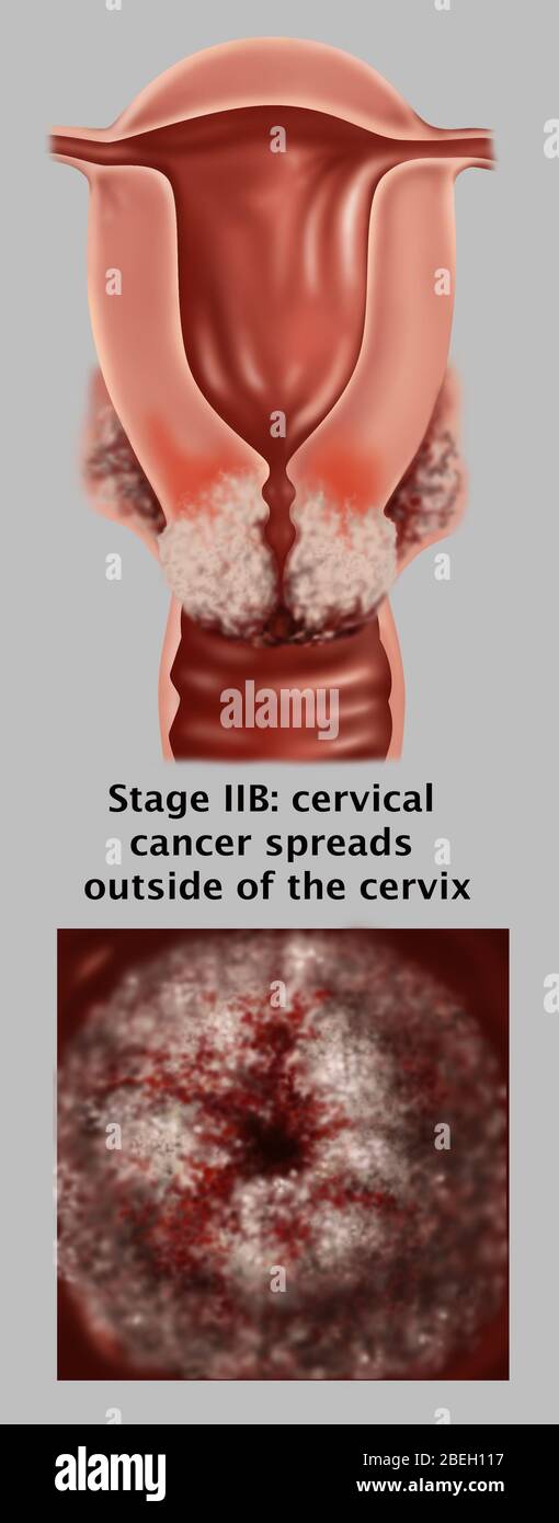stage-iib-of-cervical-cancer-stock-photo-alamy