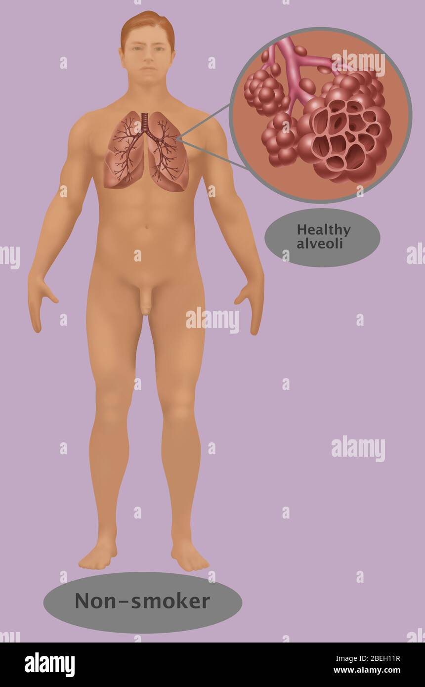 Lungs & Alveoli of a Non-Smoker Stock Photo