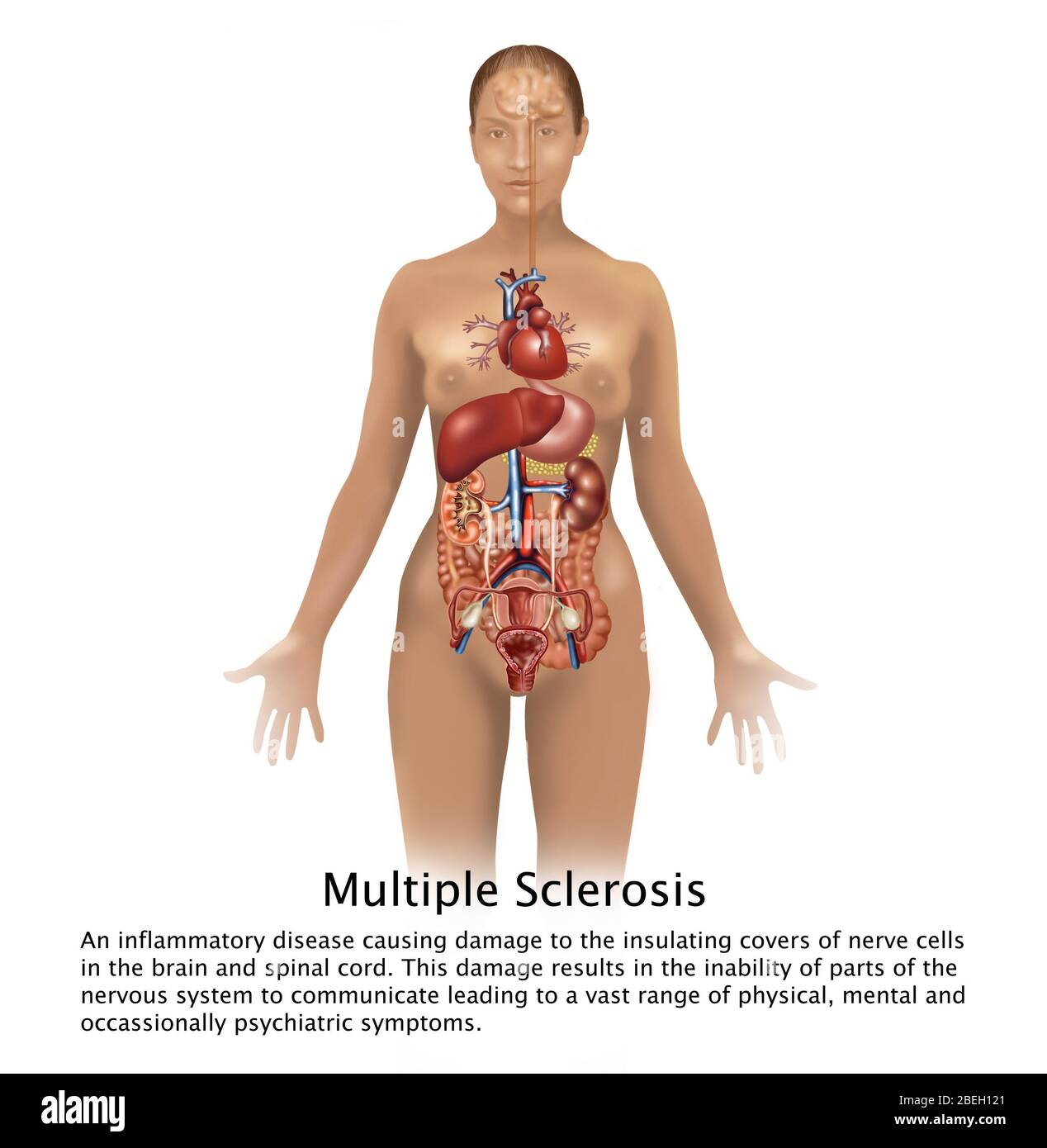 Multiple Sclerosis and Human Body Stock Photo