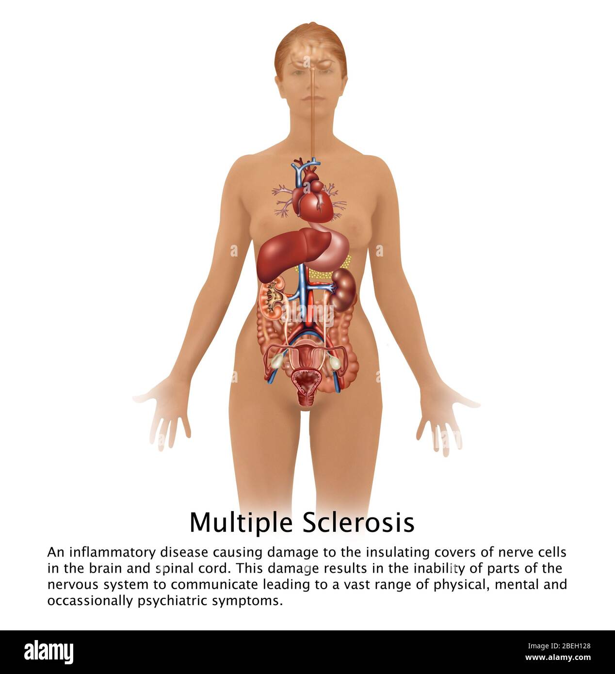 Multiple Sclerosis and Human Body Stock Photo