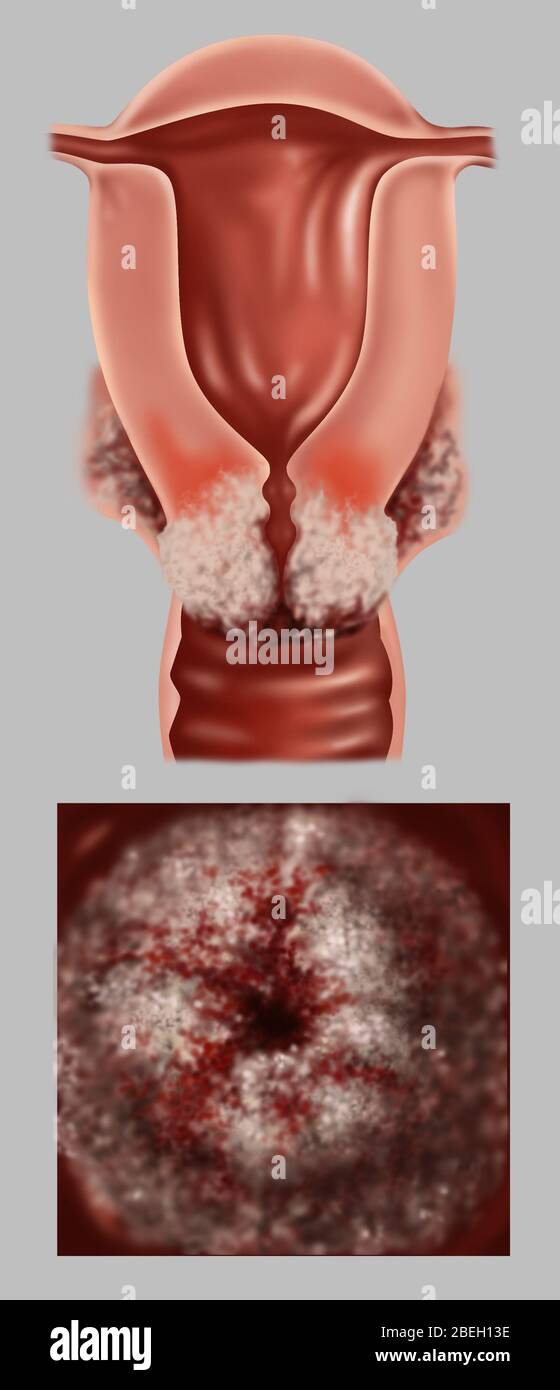 cervical-cancer-progression-hi-res-stock-photography-and-images-alamy