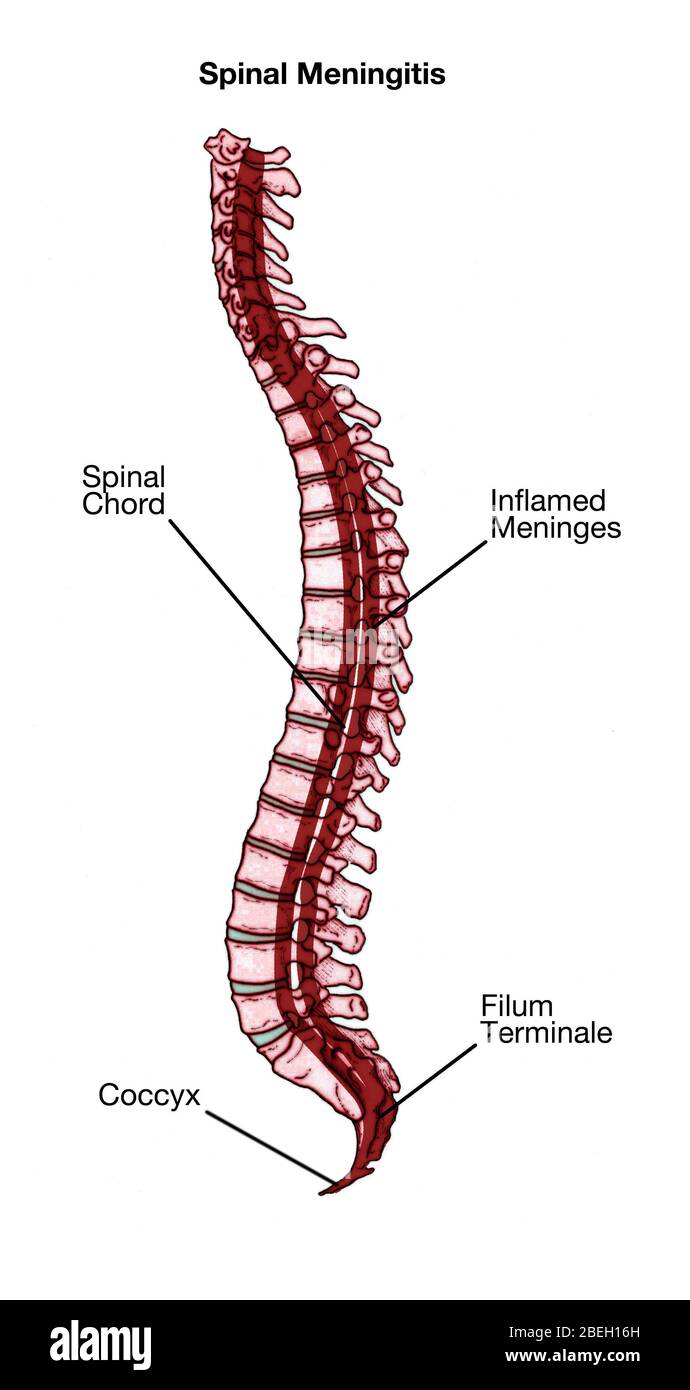 Spinal Meningitis Stock Photo
