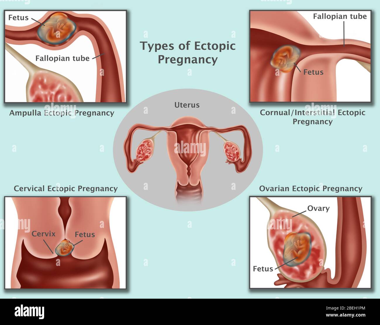 Illustration of common ectopic pregnancies. Pregnancies occurring in the Ampulla (top left), Interstitial Fallopian Tube (top right), cervix (bottom left), and the ovary (bottom right). As the ectopic pregnancy develops, the growing embryo may rupture the surrounding tissues causing serious bleeding. Surgery is usually performed to remove the embryo, and to repair or remove the area of implantation. Stock Photo