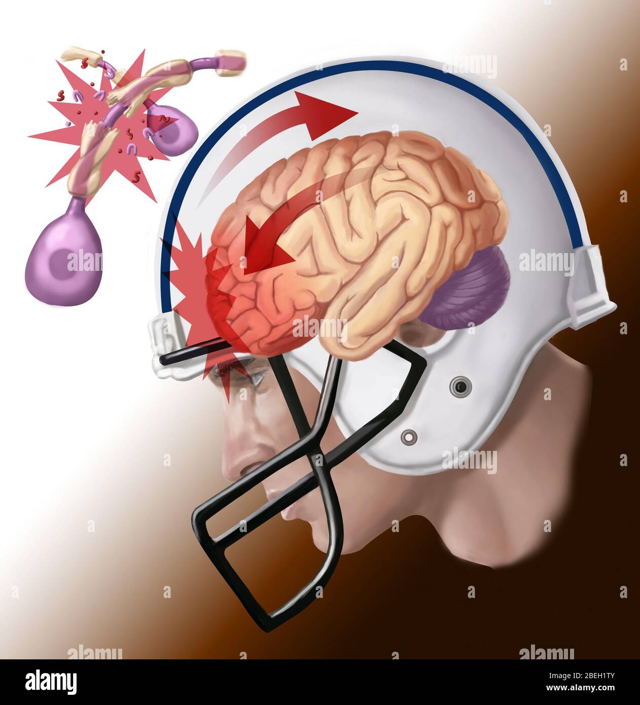 Illustration showing axon damage from a concussion, in which the brain's rotational force can cause axons to twist, tear, or break. Findings from a study of dead NFL athletes who suffered concussions suggest that lasting damage is done by axonal injuries. This damage, the severity of which increases with the cumulative number of concussions sustained, can lead to a variety of other health issues. Stock Photo