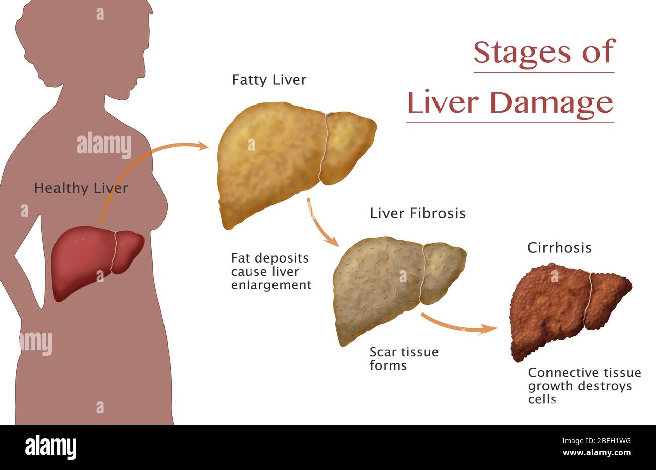 Hepatic Fibrosis Stock Photos & Hepatic Fibrosis Stock Images Alamy