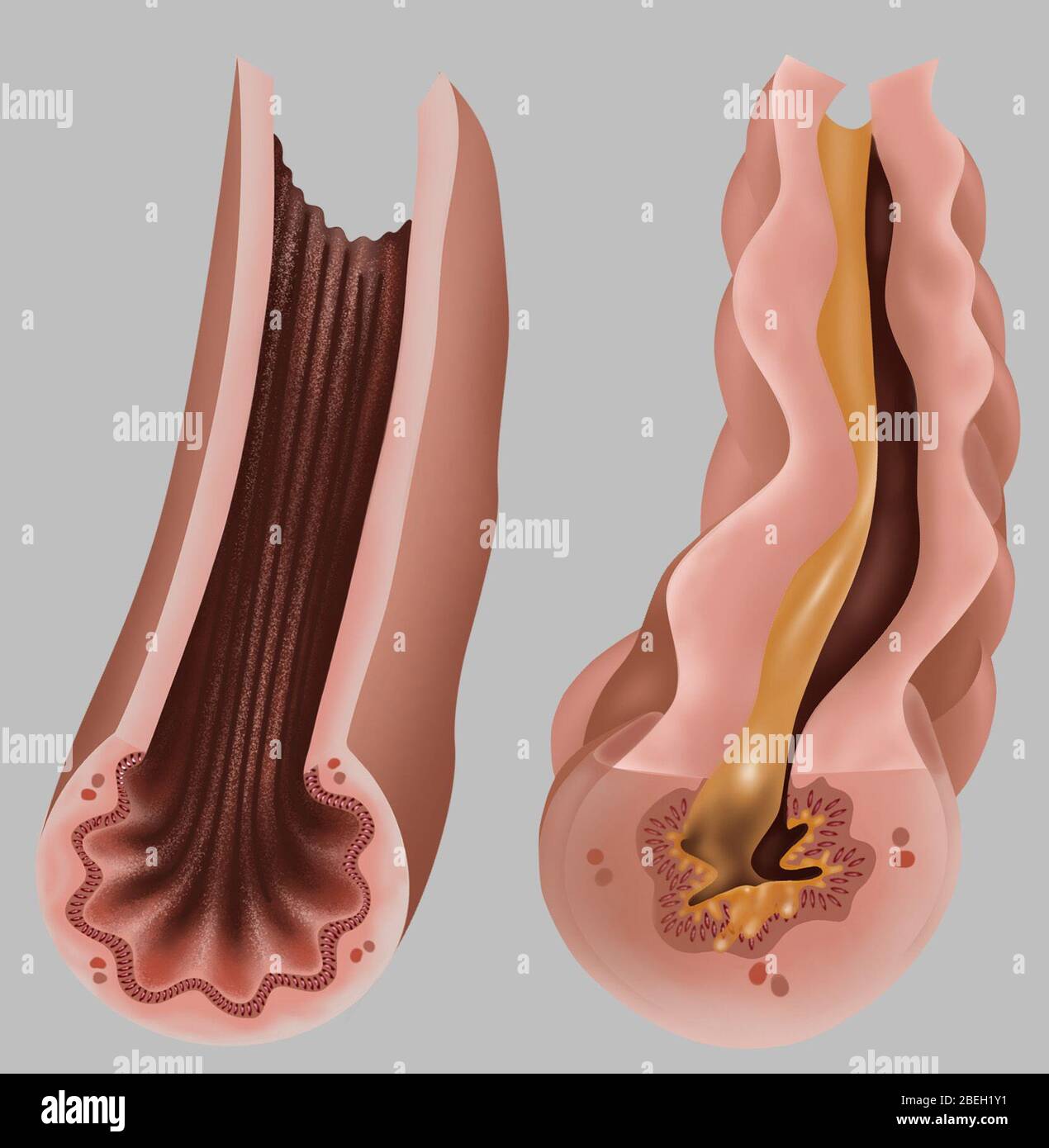 Asthma Pathology Stock Photo