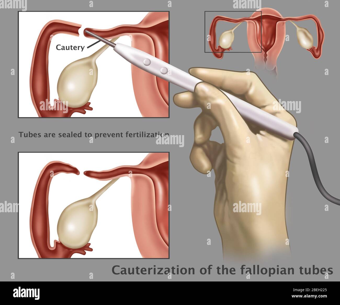 Electrocautery hi-res stock photography and images - Alamy