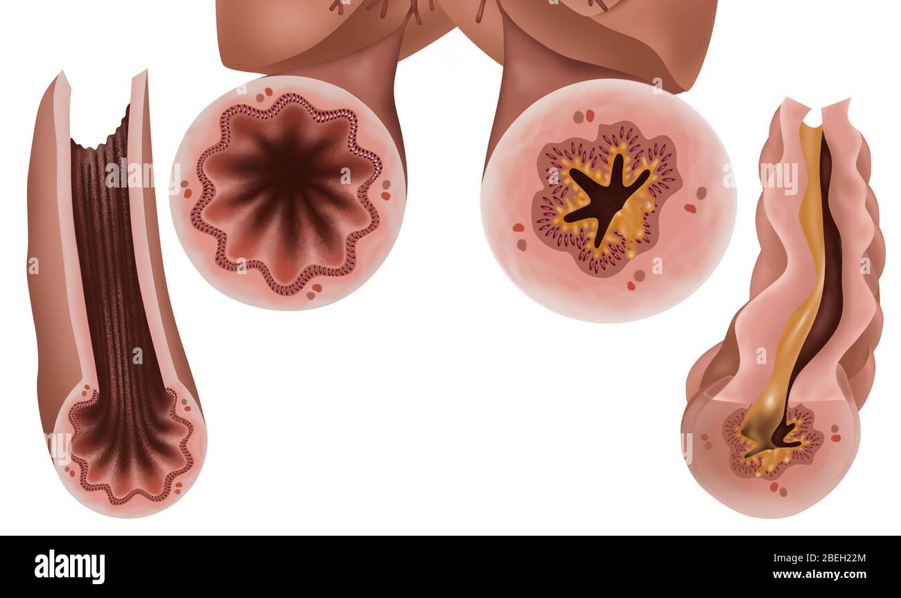 Asthma Pathology Stock Photo