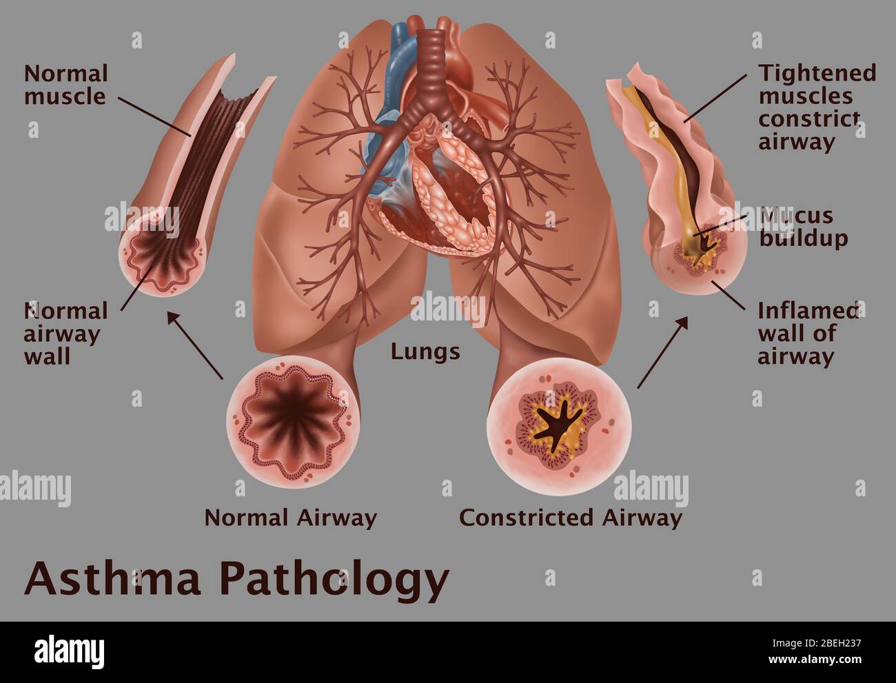 Asthma bronchial tubes hires stock photography and images Alamy