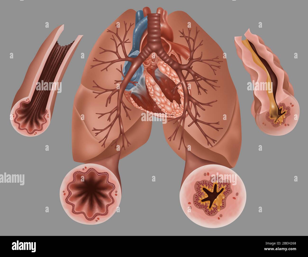 Asthma Pathology Stock Photo