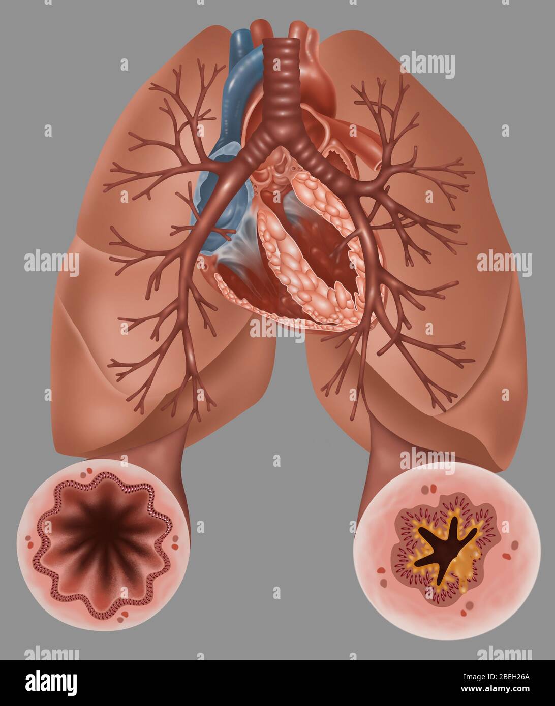Asthma Pathology Stock Photo
