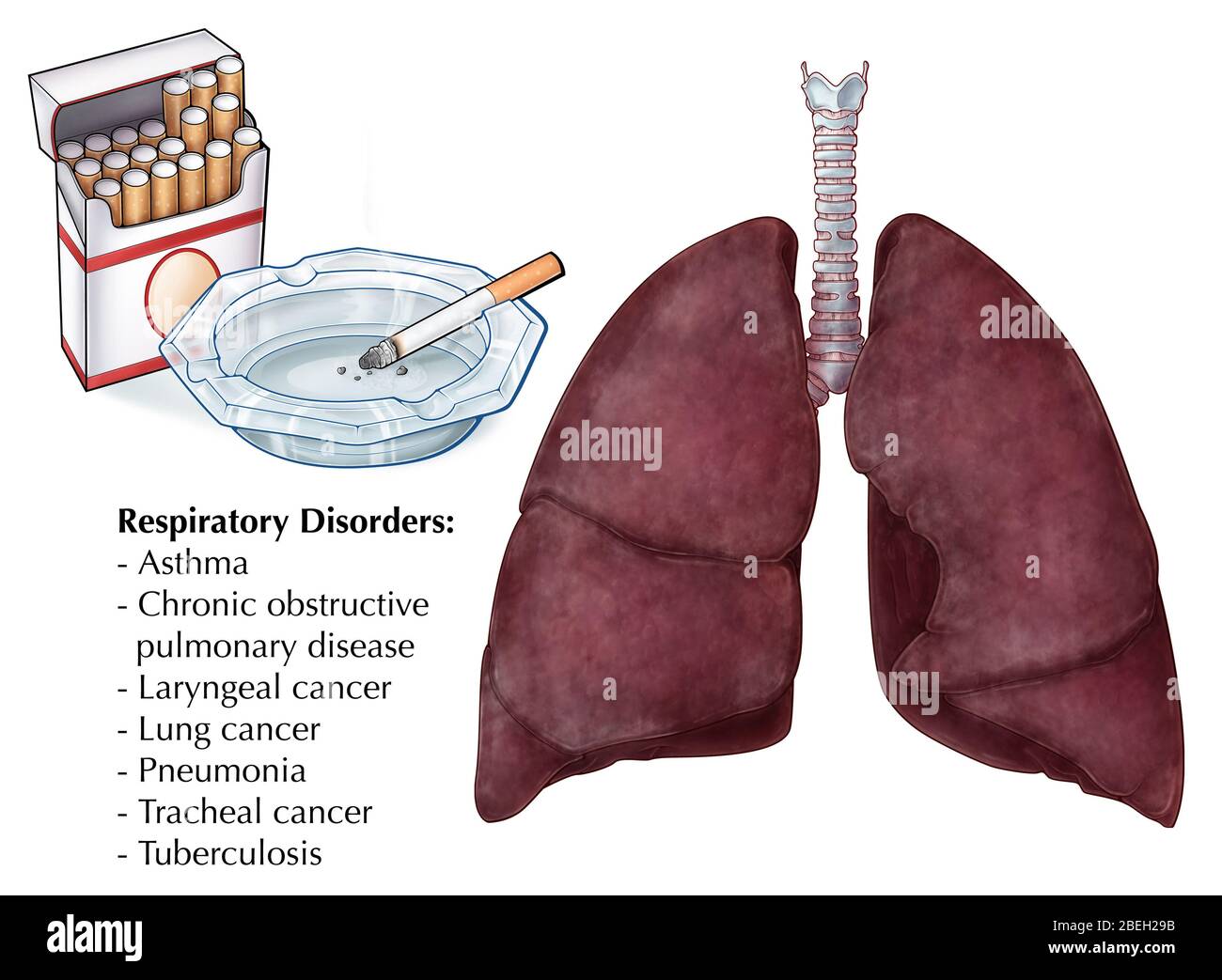 An illustration depicting cigarettes and a pair of lungs affected by smoking. A number of respiratory disorders are causally linked to smoking, including asthma, chronic obstructive pulmonary disease, laryngeal cancer, lung cancer, pneumonia, tracheal cancer, and tuberculosis. The lungs can develop a dark or decayed appearance due to the accumulation and exposure to tar and other chemicals found in cigarettes. Stock Photo