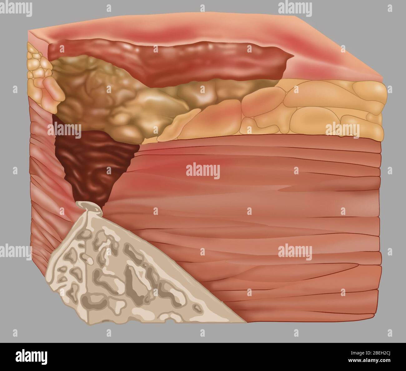 Stage 4 of a bedsore, illustration hires stock photography and images