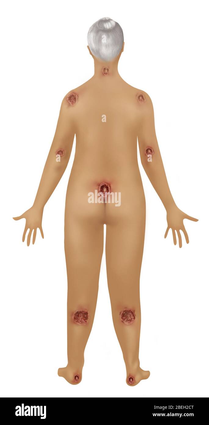 Woman with Pressure Sores, Illustration Stock Photo