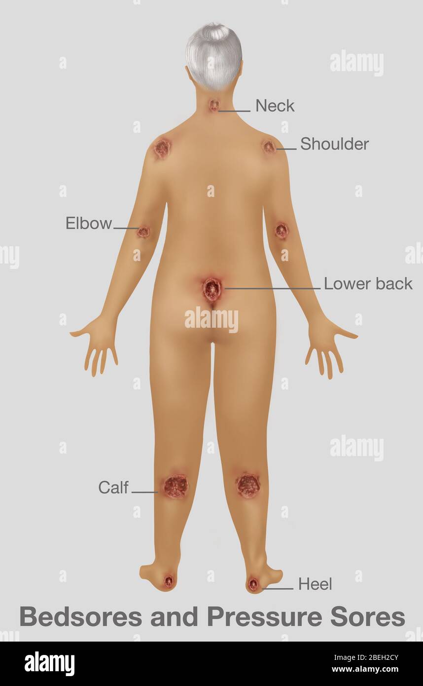Woman with Pressure Sores, Illustration Stock Photo