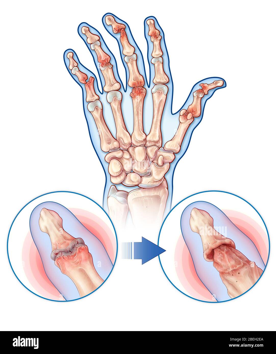 Psoriatic Arthritis, Joint Anatomy Stock Photo Alamy