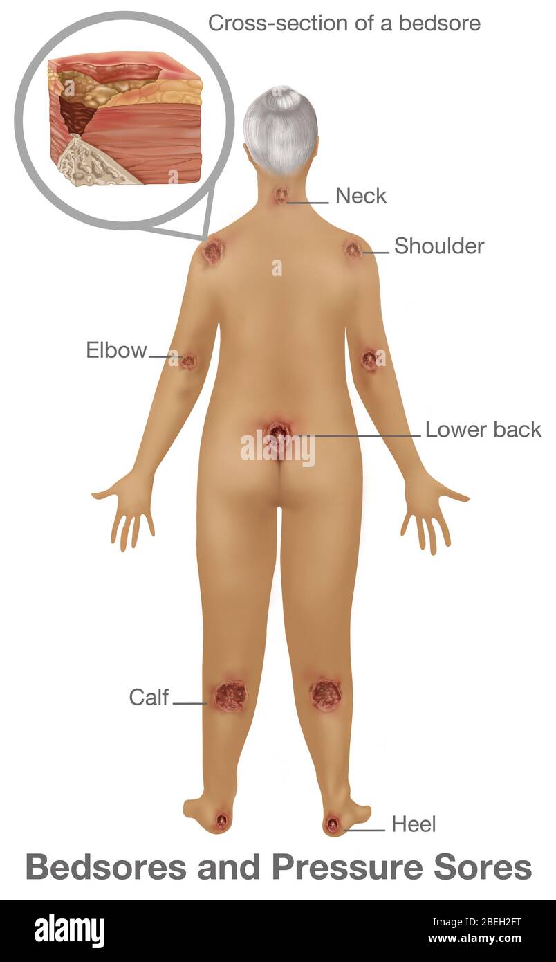 Woman with Pressure Sores, Illustration Stock Photo