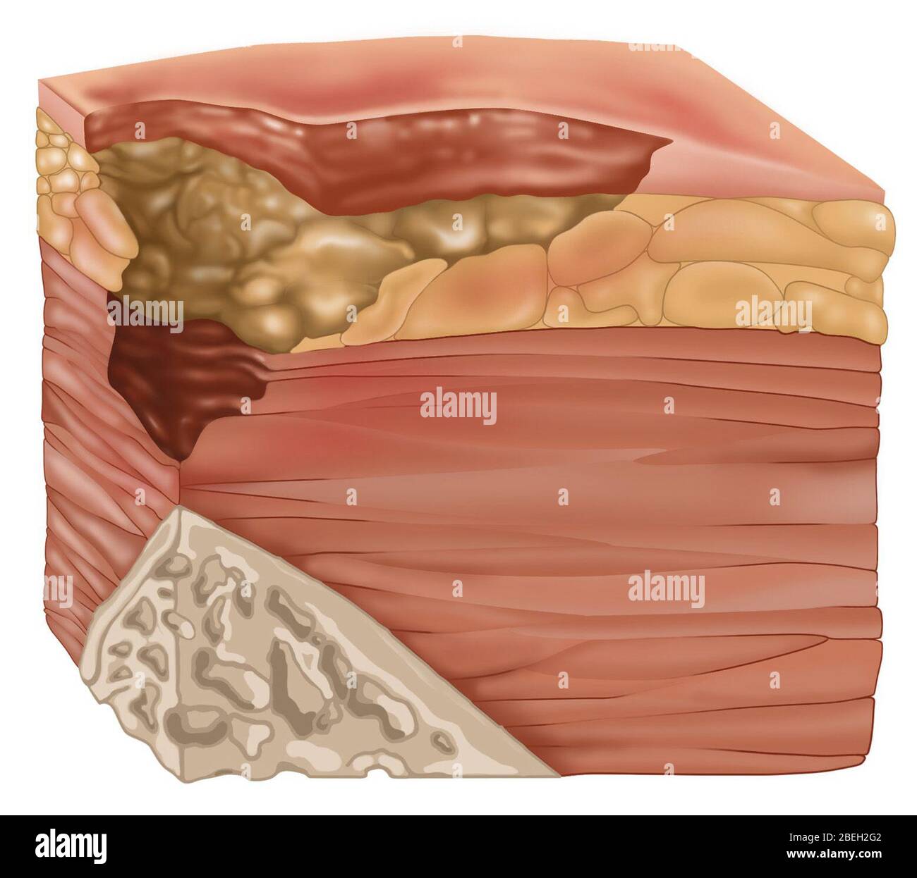 Stage 3 of a Bedsore, Illustration Stock Photo