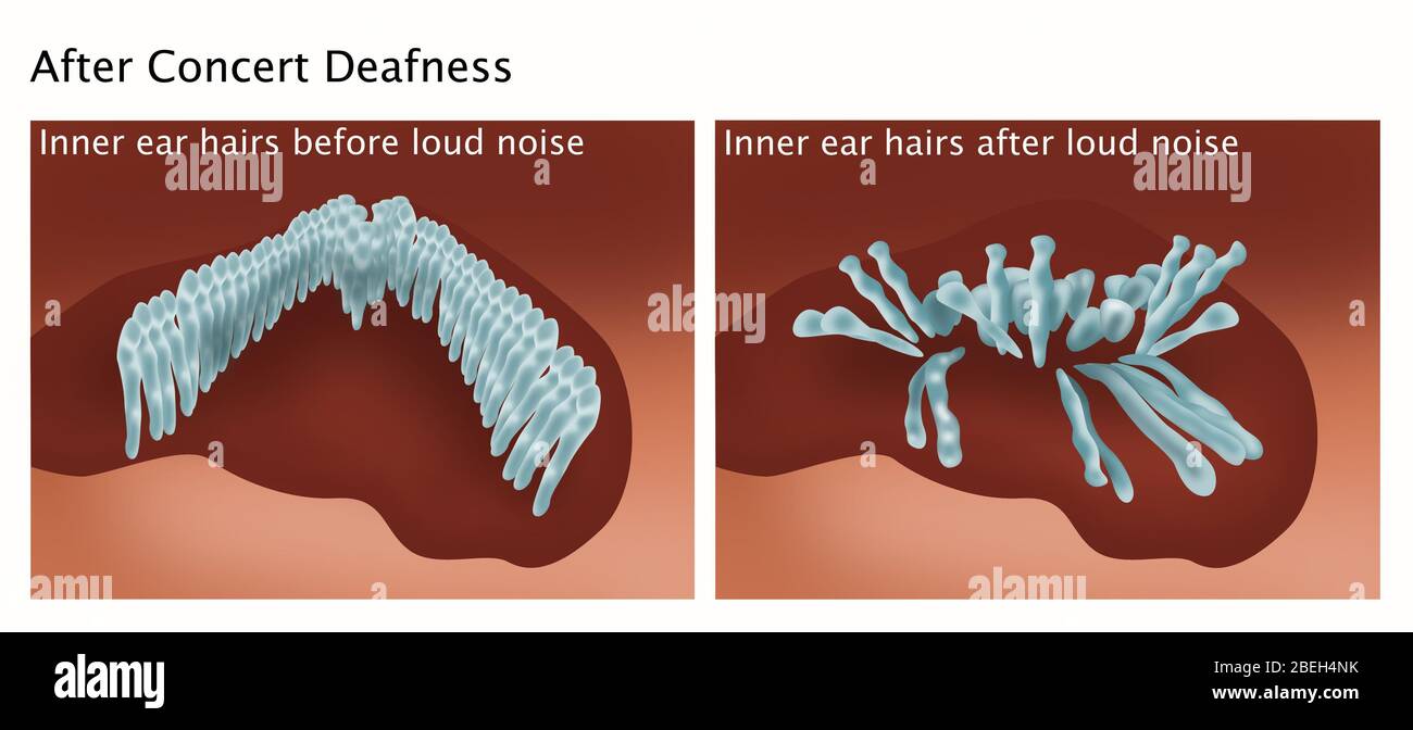 Noise induced hearing loss hires stock photography and images Alamy