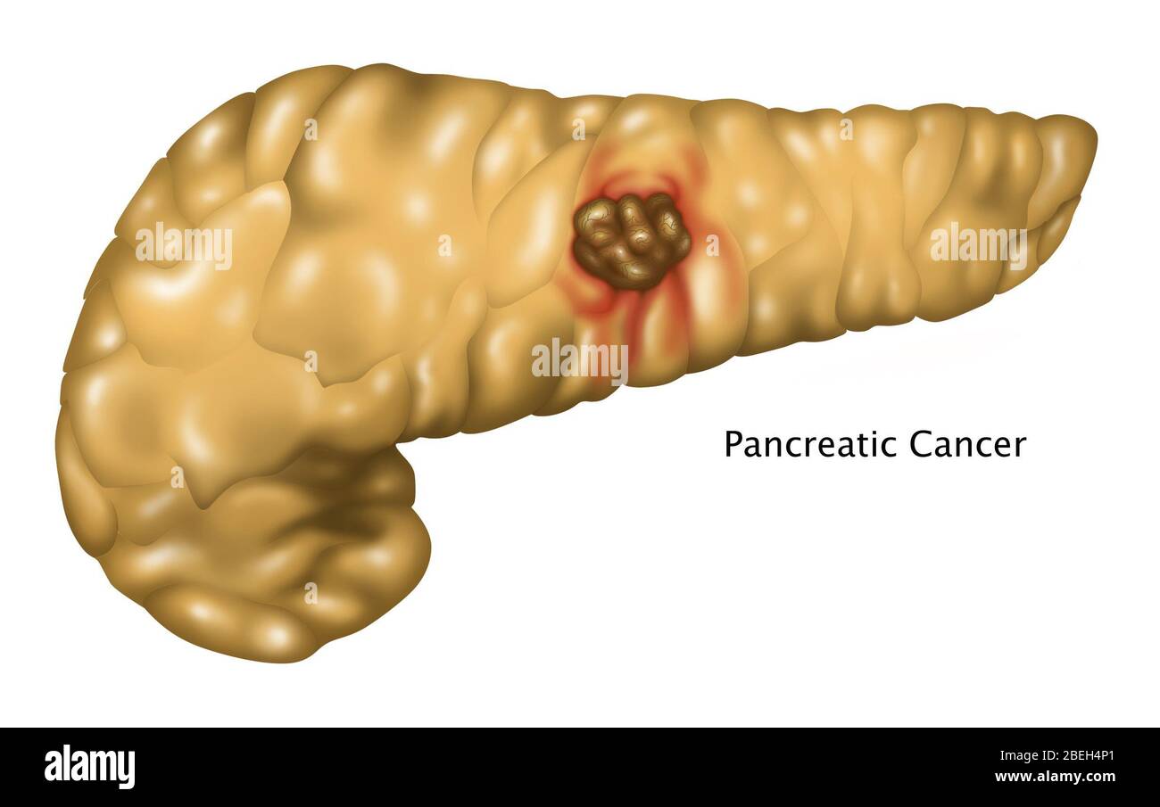 Illustration of pancreatic cancer. At center of the pancreas is a tumor (brown area). Stock Photo