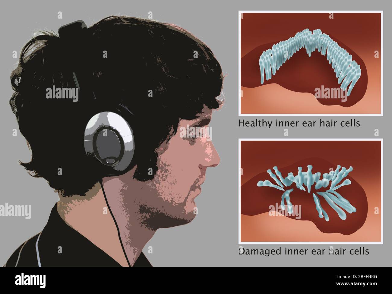 Noise induced hearing loss hires stock photography and images Alamy