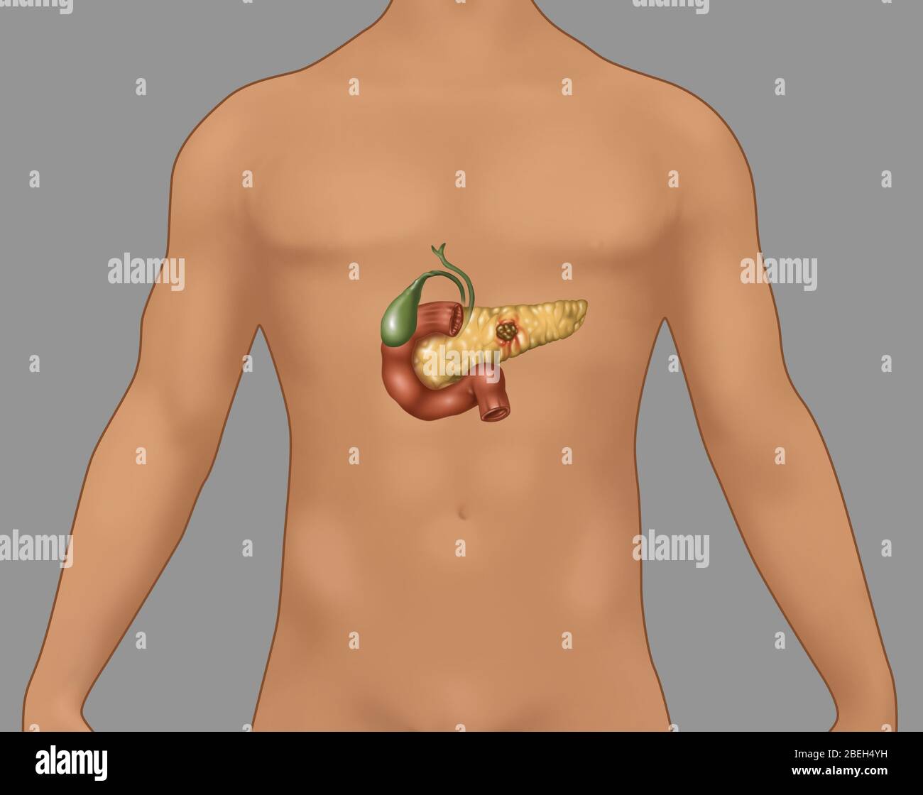 Pancreatic Cancer in Male Figure, Illustration Stock Photo