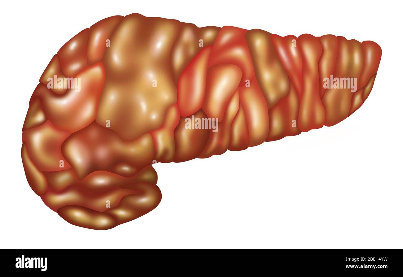 Illustration of an inflamed pancreas (Pancreatitis). Pancreatitis may be acute or chronic, but either type can be very severe and have serious complications. Stock Photo